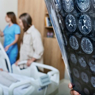 Rising Stroke Rates in Young People: Causes and Prevention